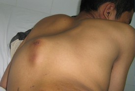 Tumor Tulang Belakang 